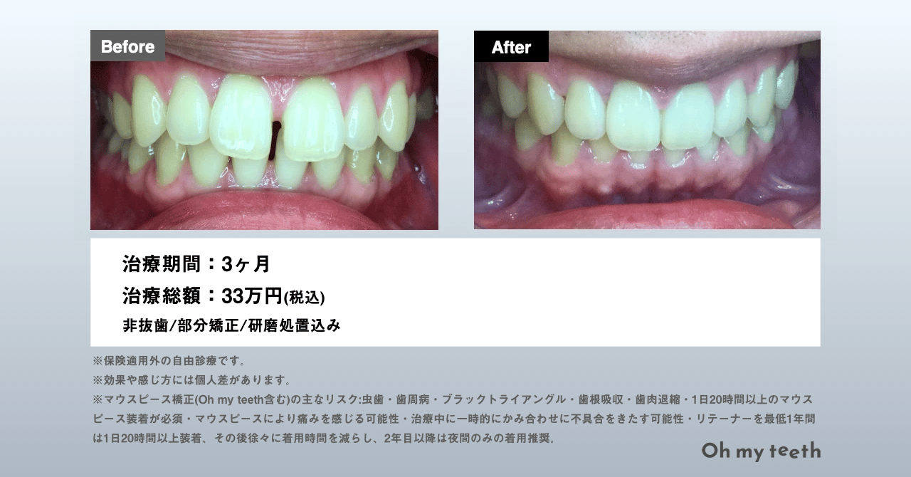 マウスピース矯正 Oh my teethのすきっ歯(空隙歯列)の症例