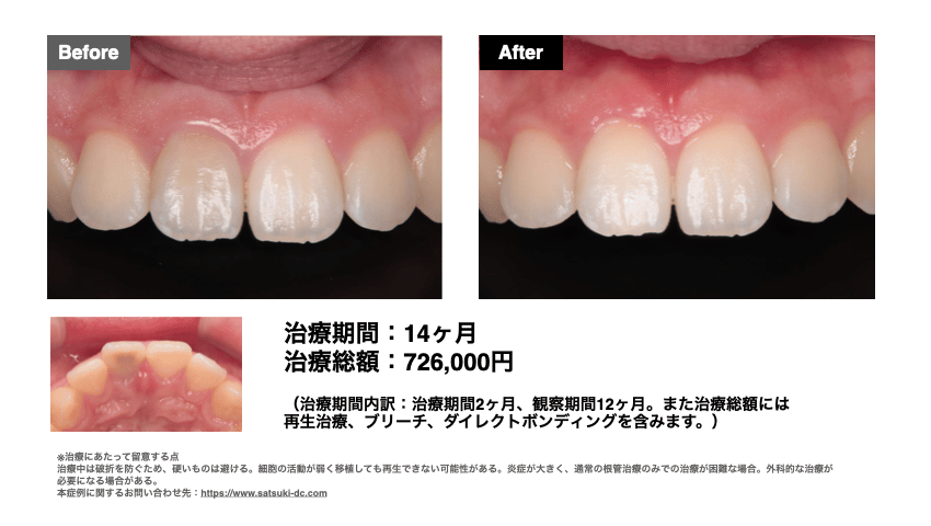 歯髄治療:症例写真