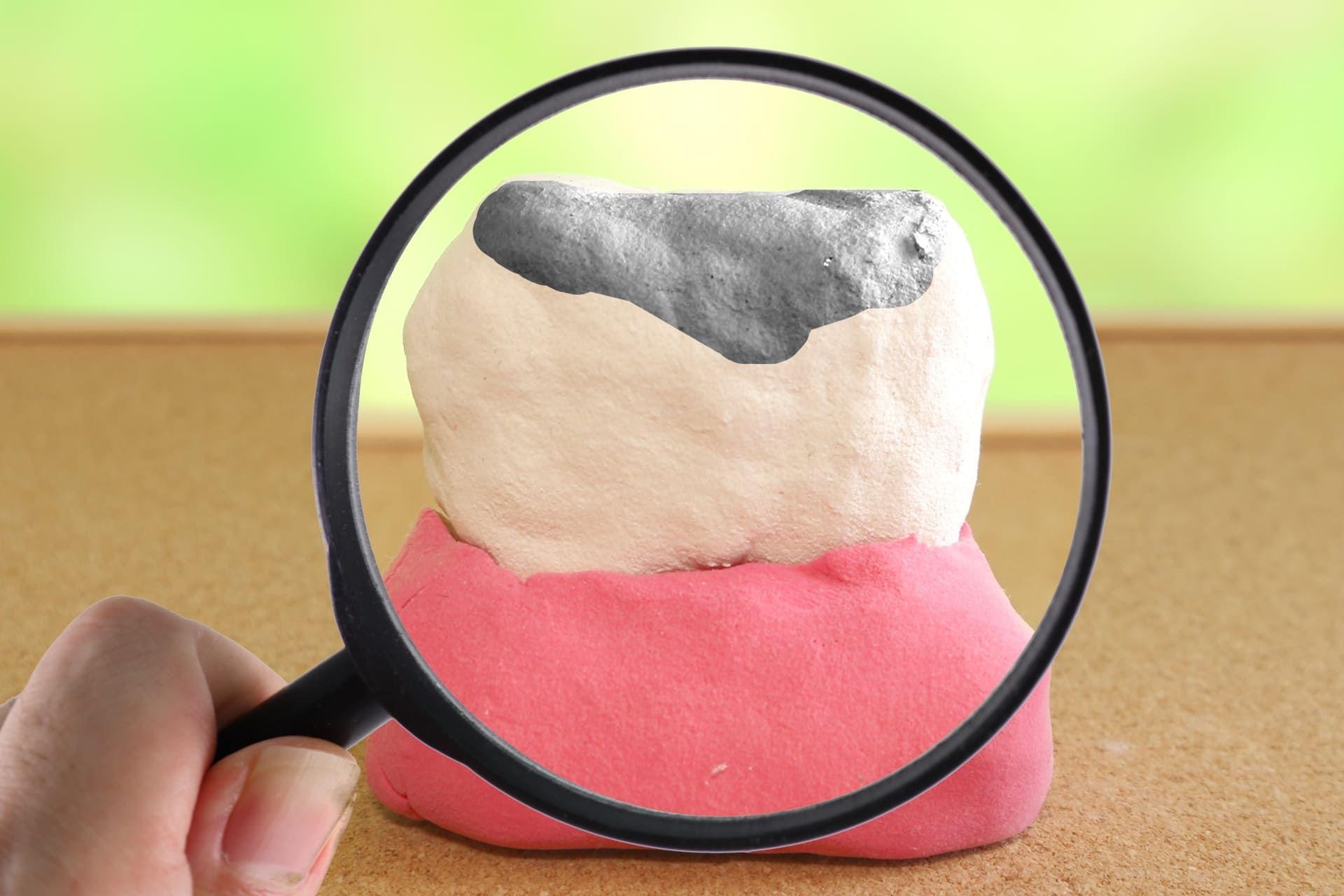 虫歯のイメージ