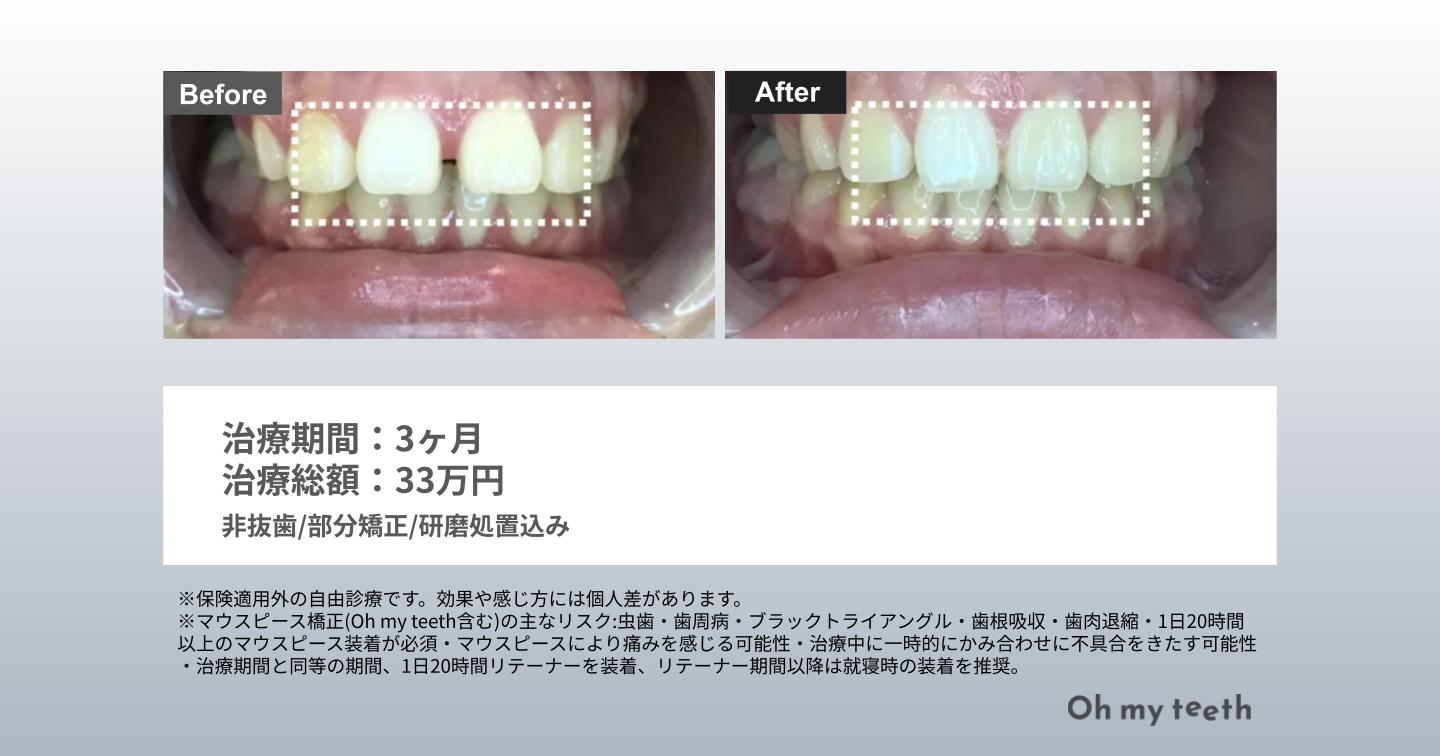 マウスピース矯正 Oh my teethの症例(すきっ歯・空隙歯列)