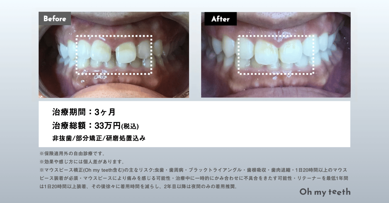 マウスピース矯正 Oh my teethの症例(すきっ歯・空隙歯列)