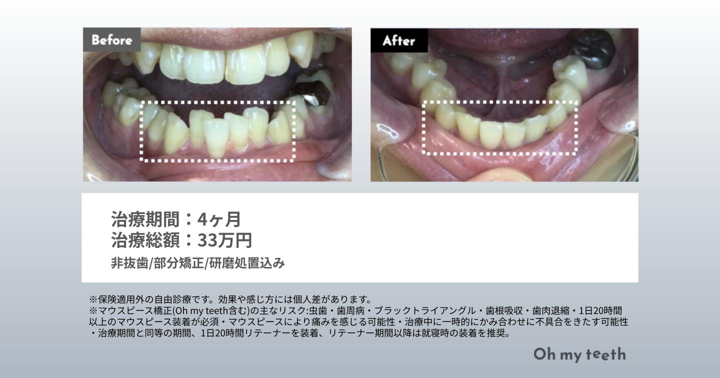 マウスピース矯正 Oh my teethのガタガタ歯の症例