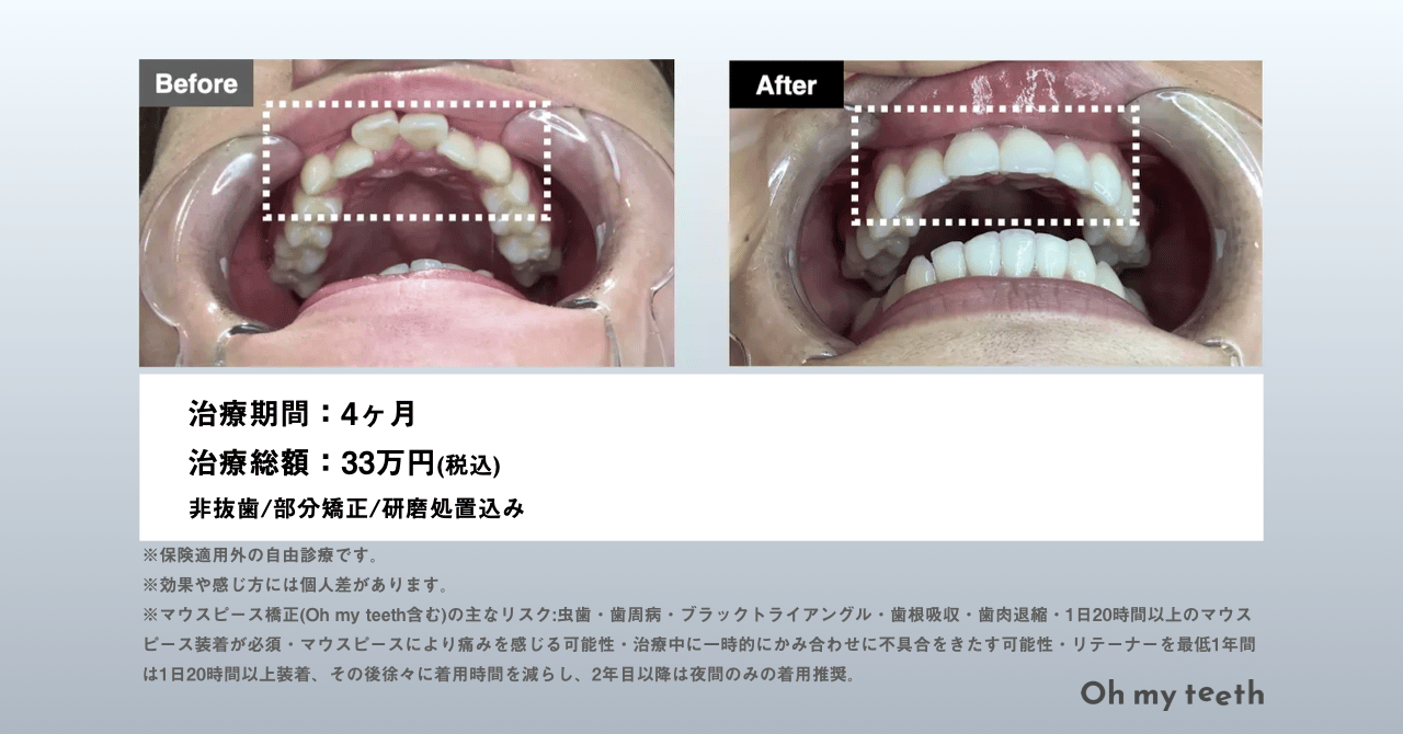 Oh my teethマウスピース矯正の症例(上前歯がたつき)