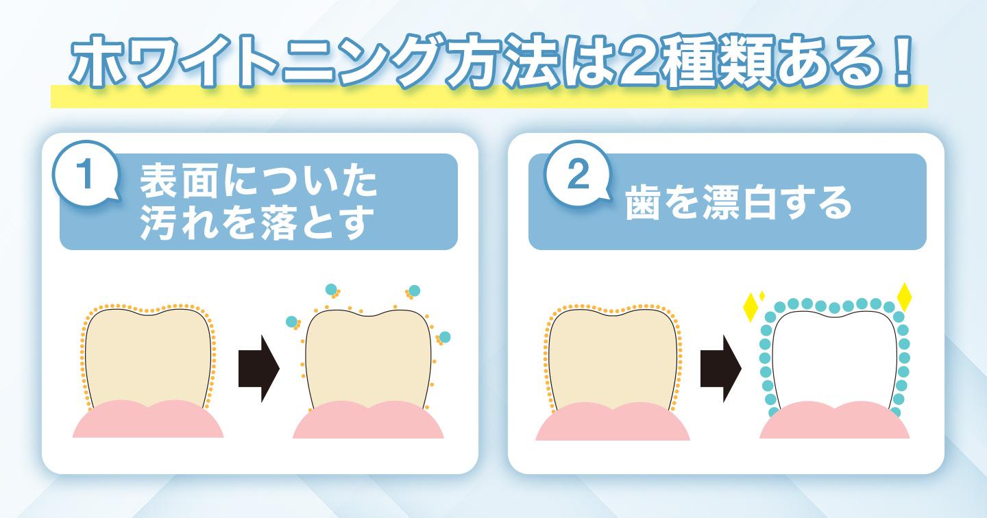 ホワイトニング方法は2種類ある！