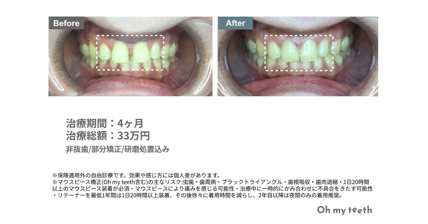 すきっ歯の症例写真