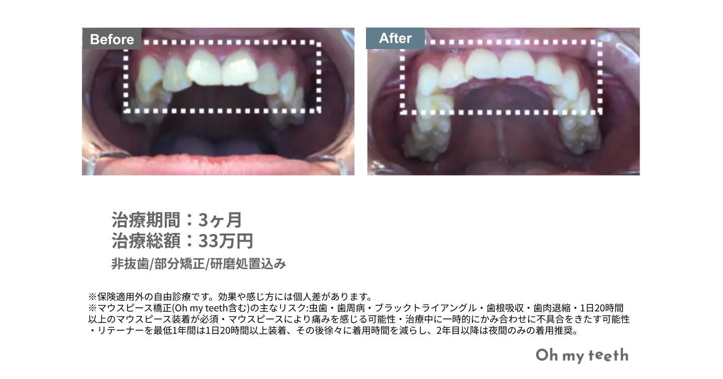 叢生・ガタガタの歯並びの症例写真
