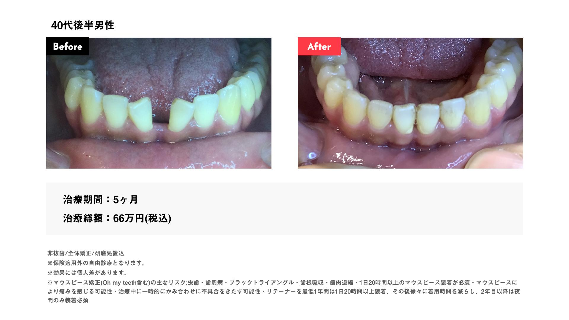 40代後半男性 すきっ歯 全体矯正 ビフォーアフター
