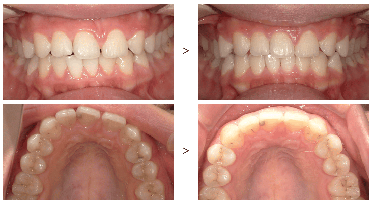 ホワイトライン矯正の口コミ・対応症例・他ブランドとの違いを徹底解説！