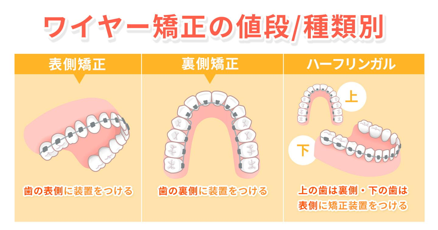 ワイヤー矯正相場4種類別