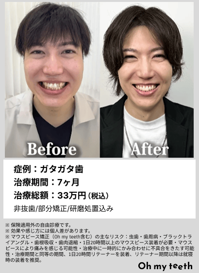 全顔BA・ガタガタ歯