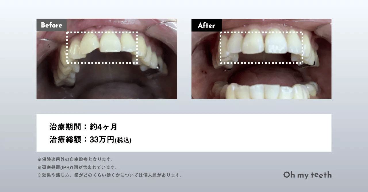 マウスピース矯正 Oh my teethの症例(前歯のズレ)