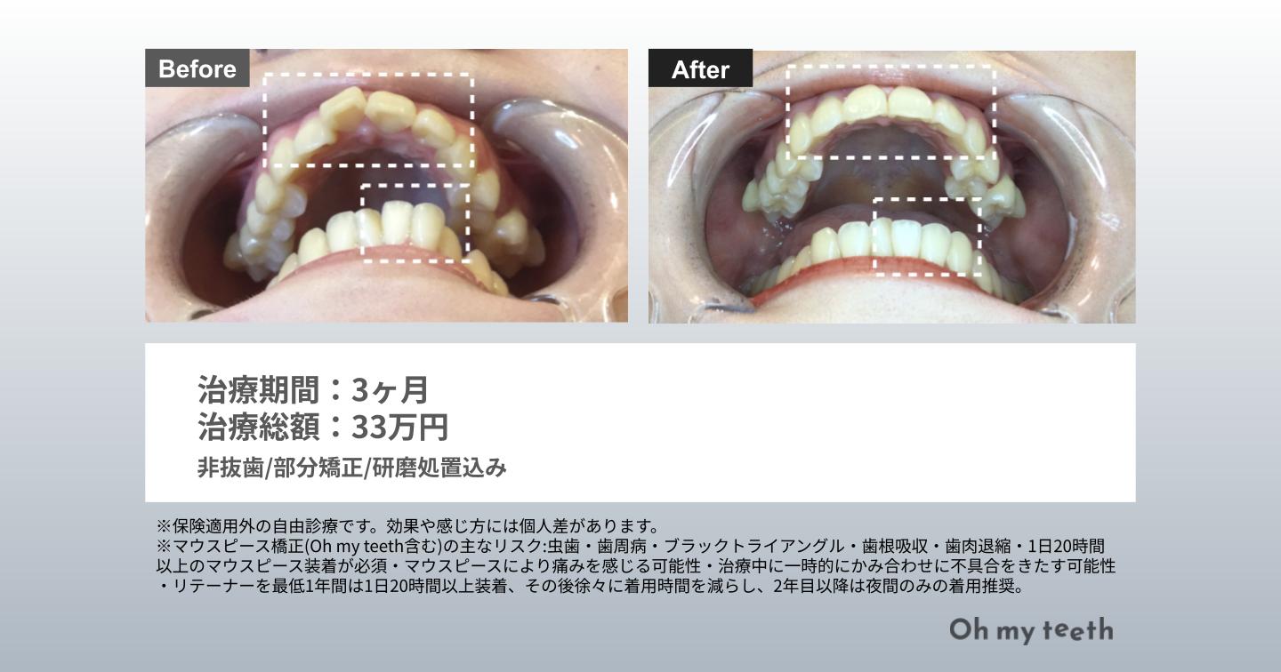 マウスピース矯正 Oh my teethの出っ歯の症例