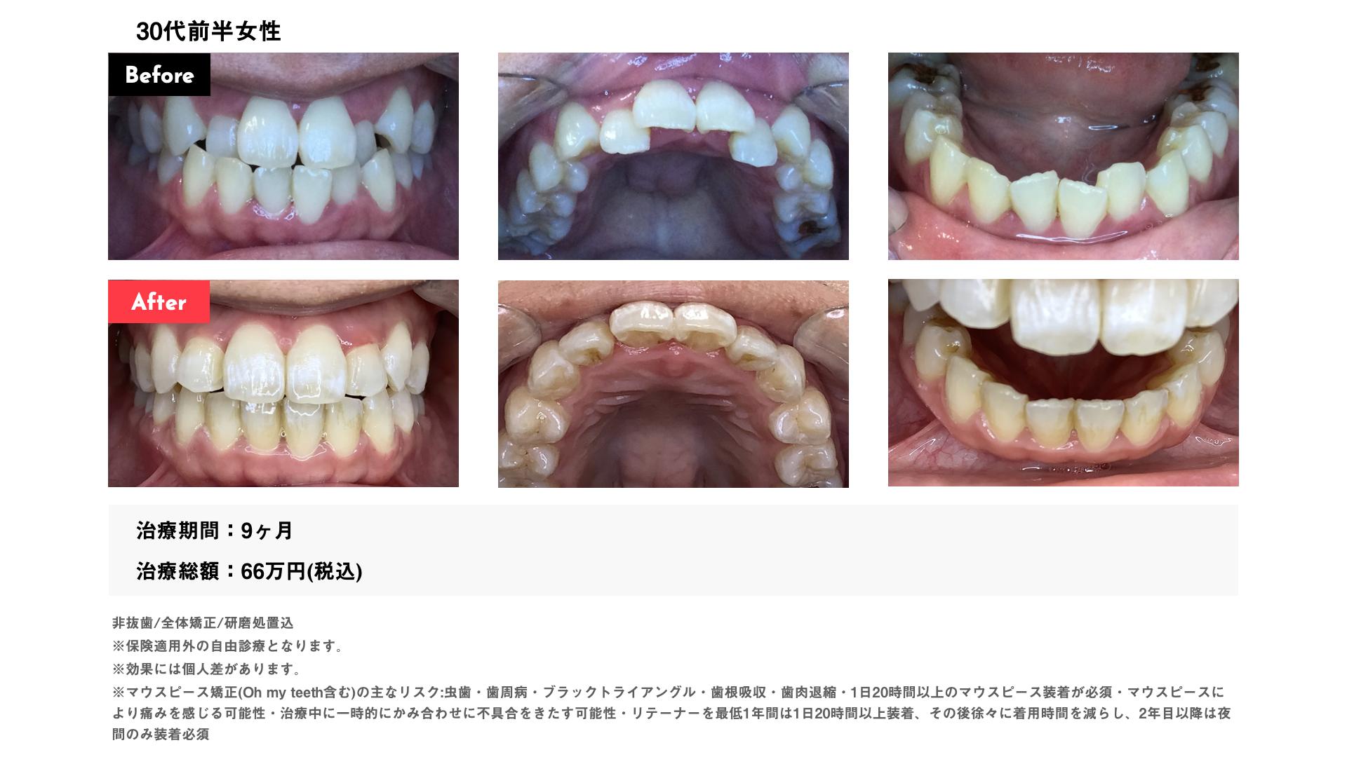 受け口 30代前半女性 症例写真