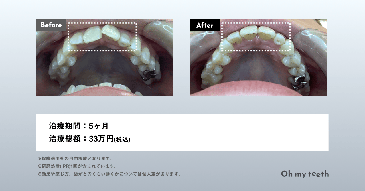 妊娠中に矯正しても大丈夫?レントゲンや抜歯など注意点を解説