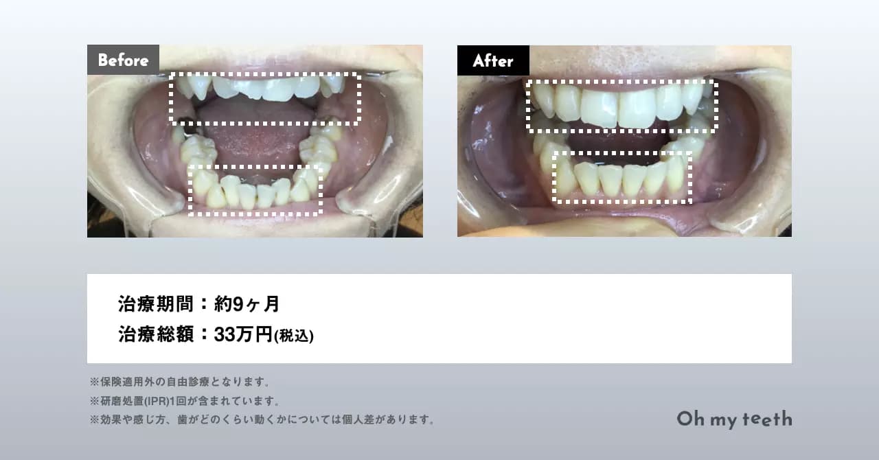 E・Tさんの症例 Basic 前歯のがたつき（上下） 八重歯