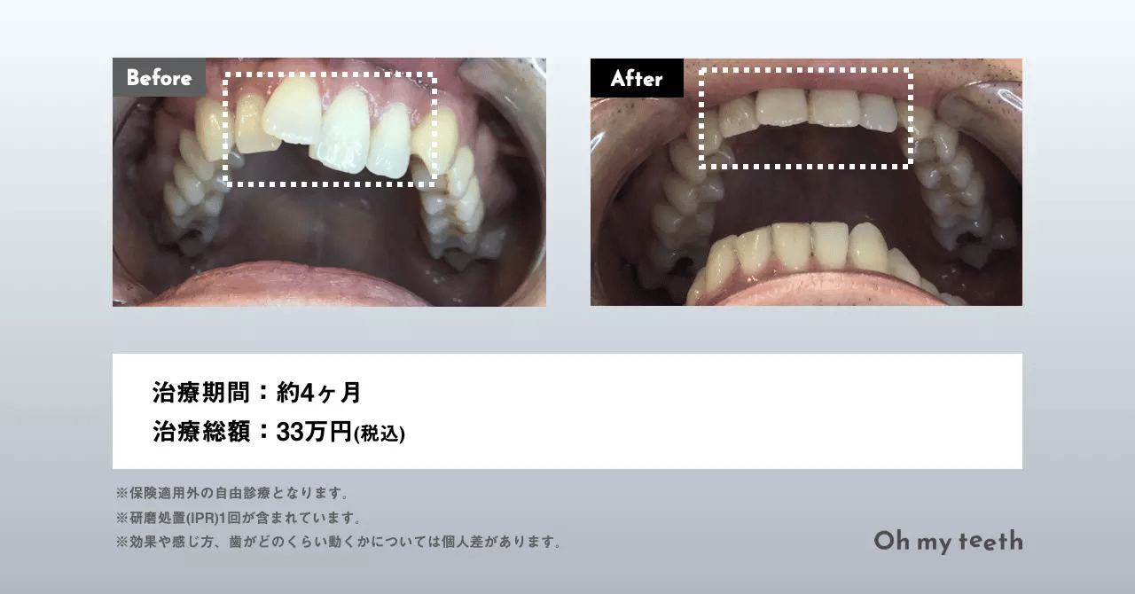 歯の整形って？種類・費用・期間・リスクを解説