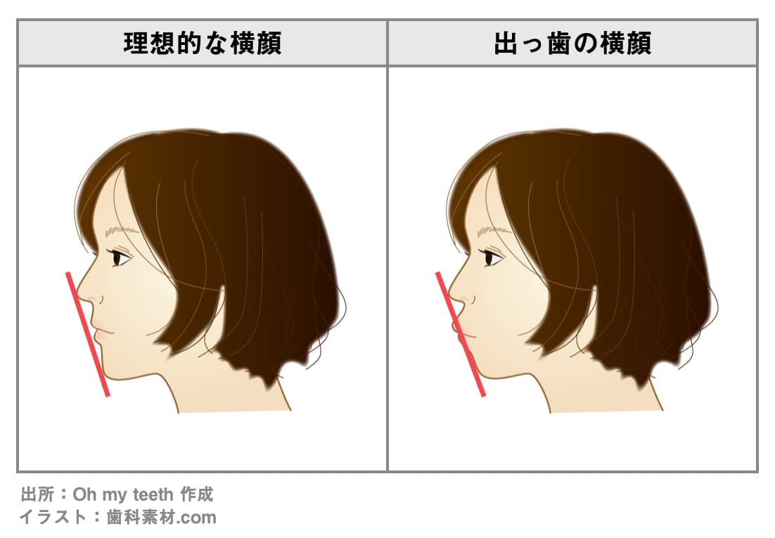 理想的な横顔と出っ歯の横顔