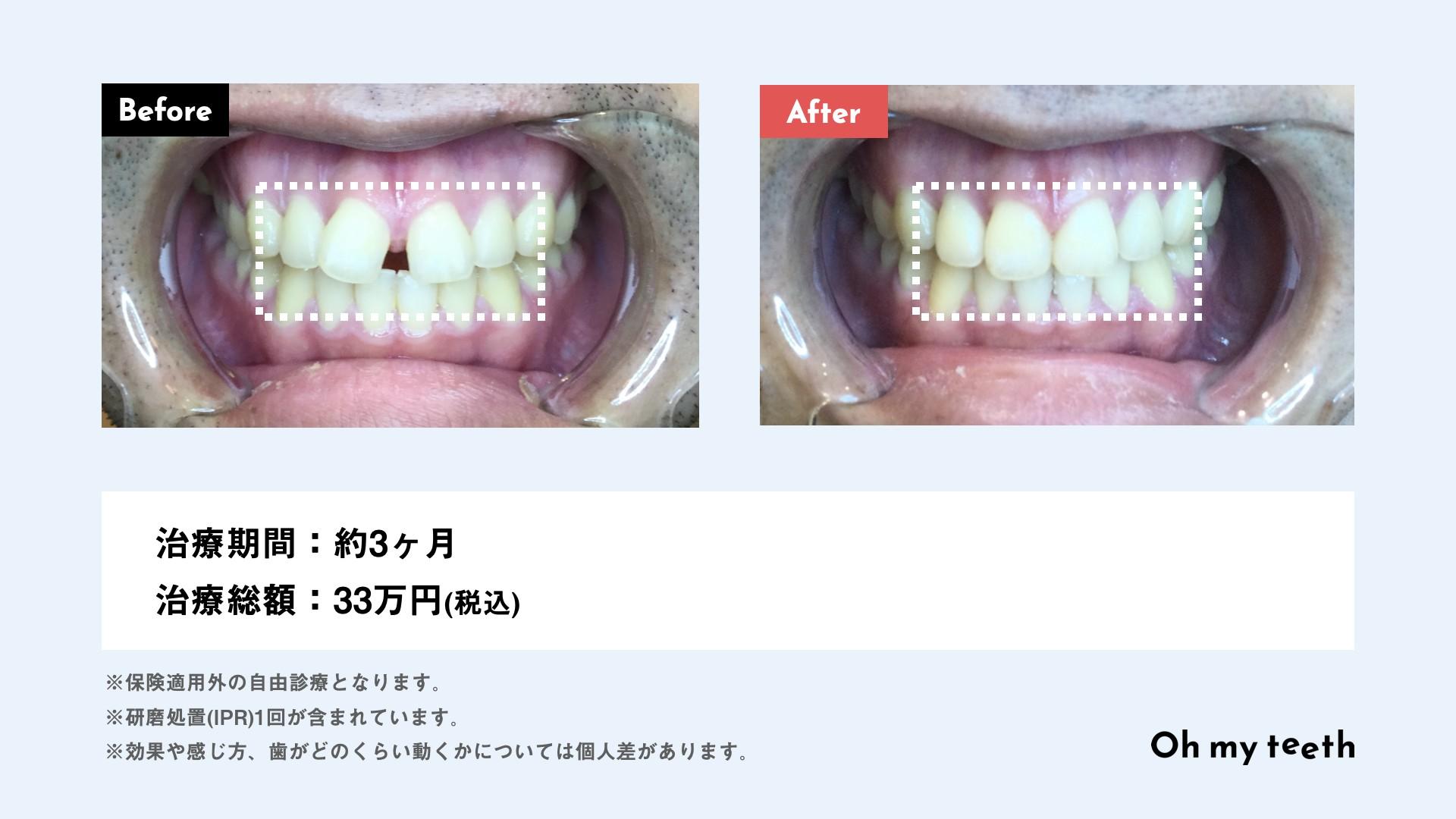 Oh my teeth 症例3