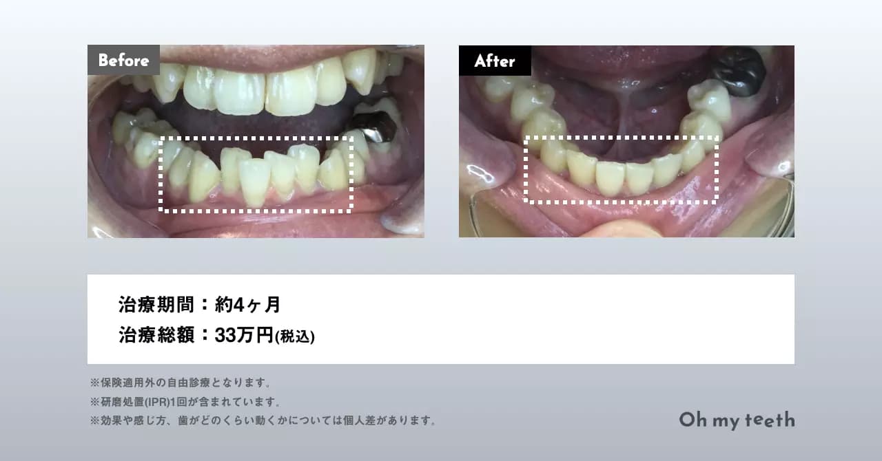 T・Oさんの症例 前歯のがたつき（下） 約4ヶ月 (1)