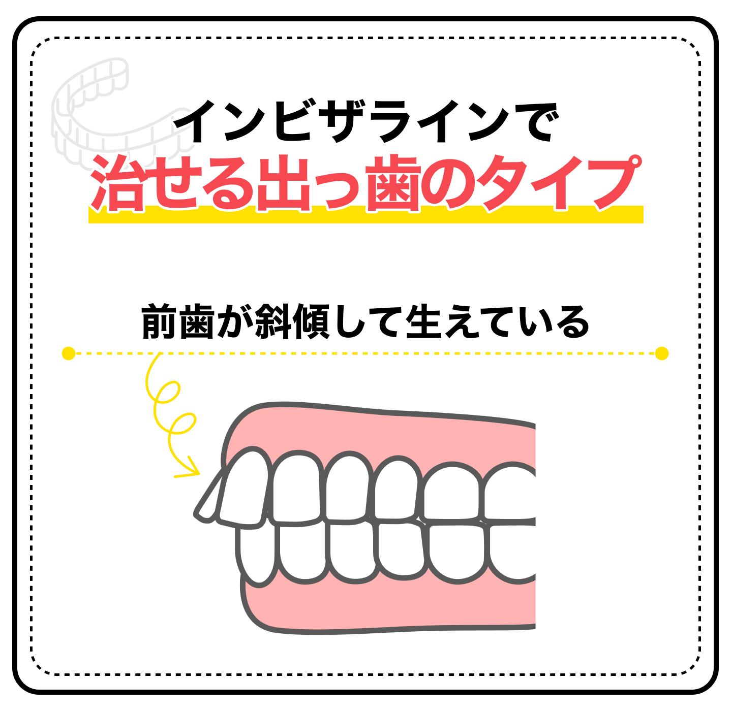 説明画像2(出っ歯はインビザライン矯正で治せる?)