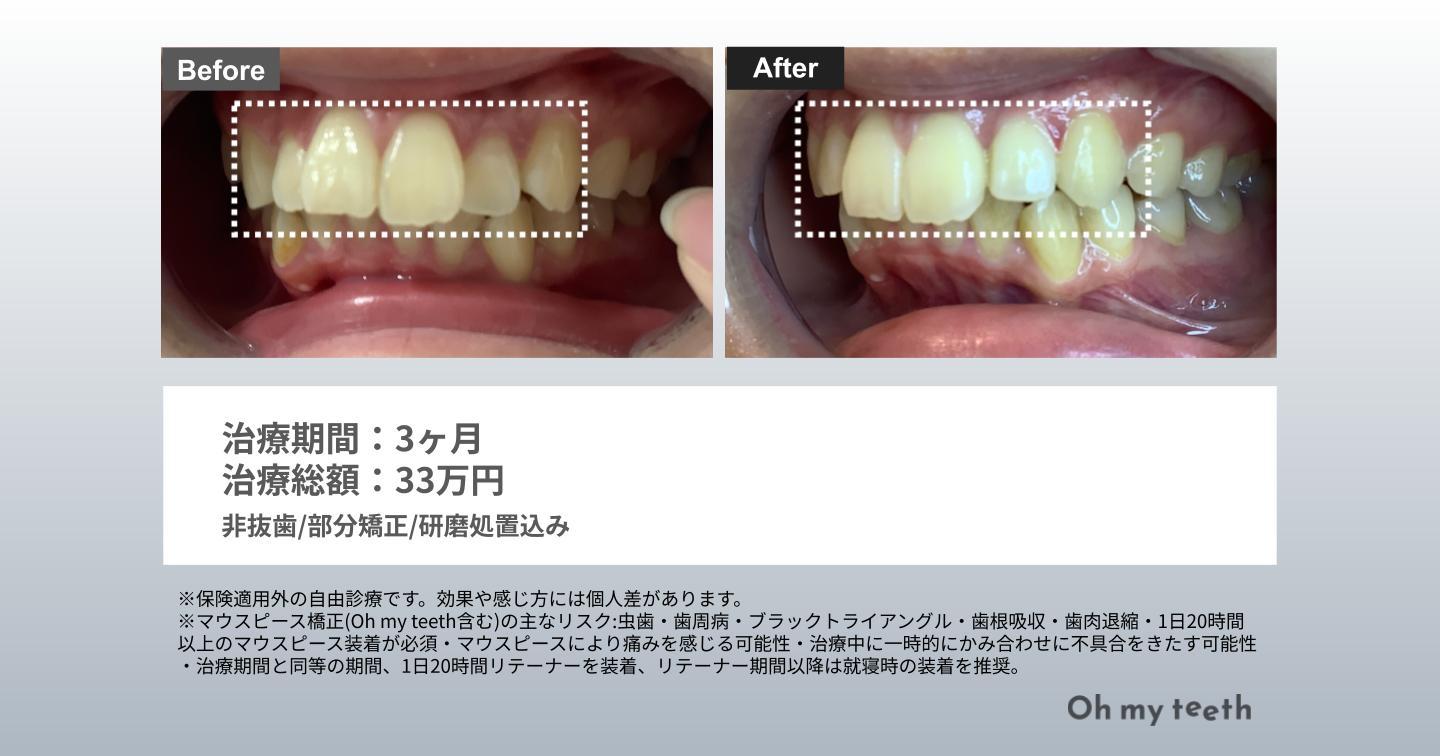 八重歯症例　basic