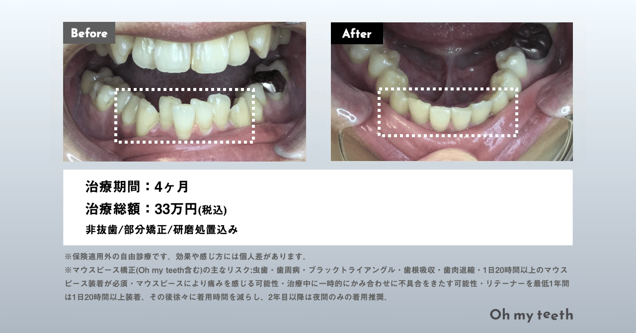 マウスピース矯正 Oh my teethのデコボコの歯並び(叢生)の症例(部分矯正・非抜歯矯正)