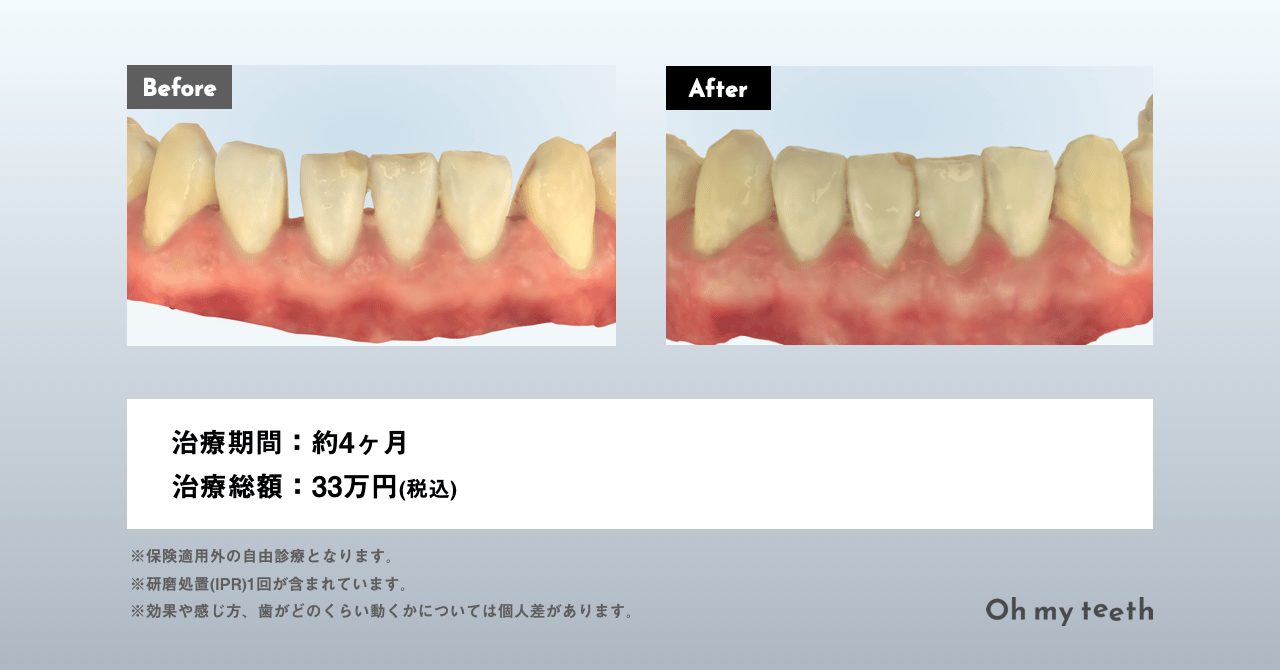 マウスピース矯正中の運動はOK？制限や注意点を解説