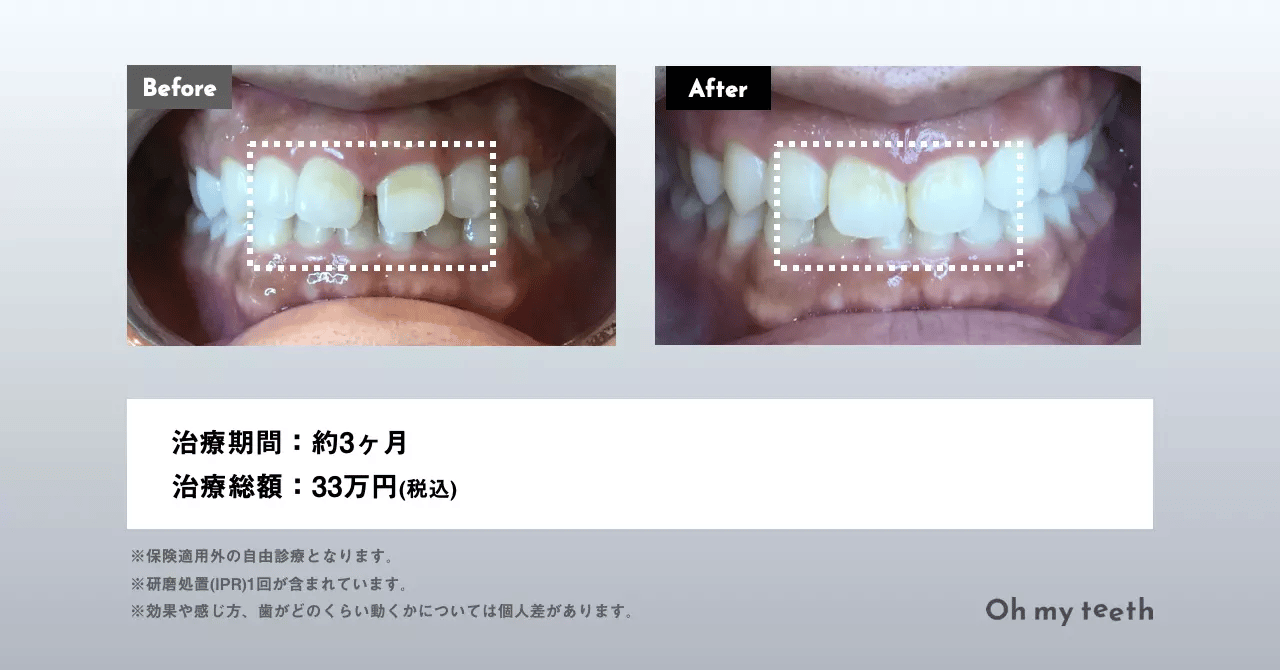 マウスピース矯正 Oh my teethの症例(上前歯すきっ歯)