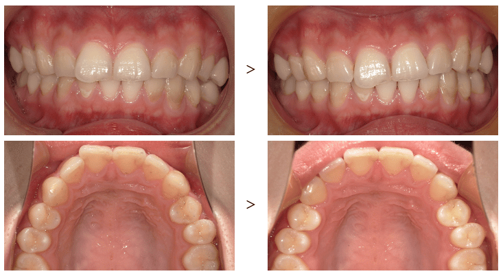 ホワイトライン矯正の口コミ・対応症例・他ブランドとの違いを徹底解説！