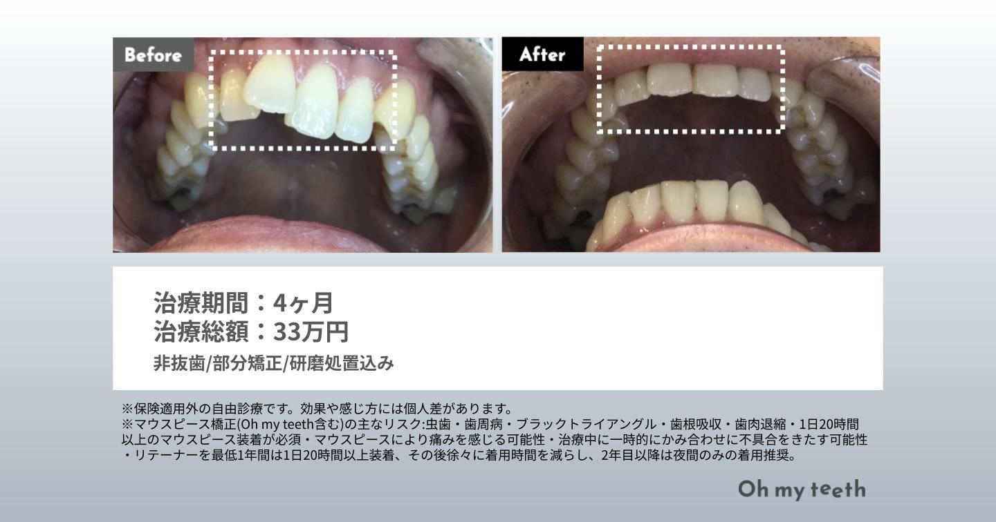 マウスピース矯正 Oh my teethの症例(出っ歯)