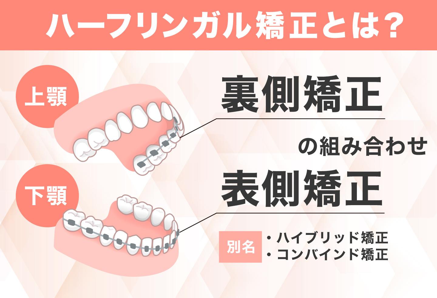 ハーフリンガル矯正とは?