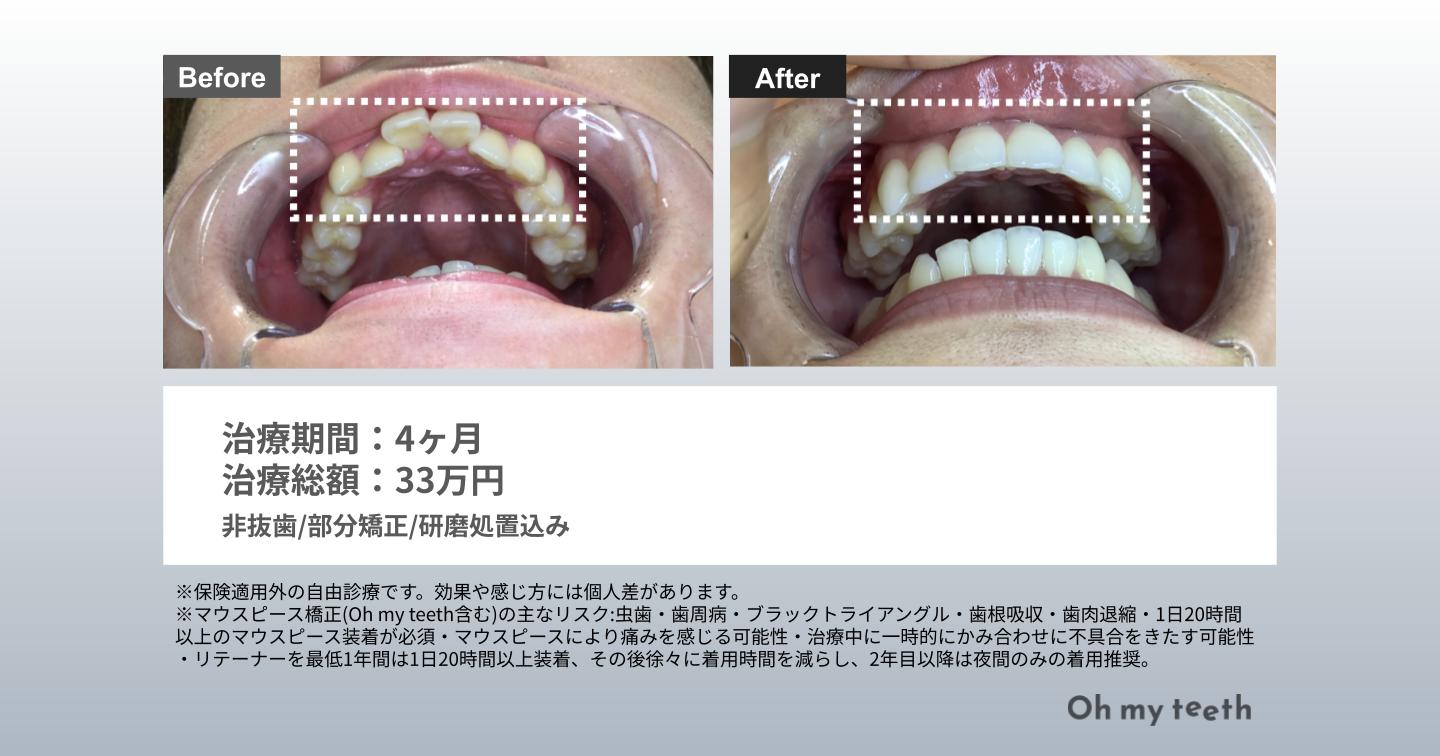 マウスピース矯正 Oh my teethの出っ歯の症例