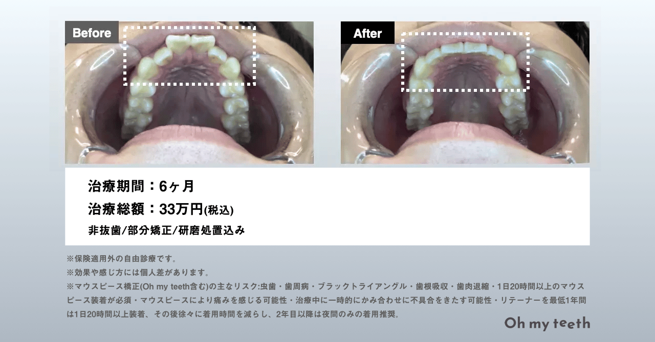 マウスピース矯正 Oh my teethの出っ歯の症例