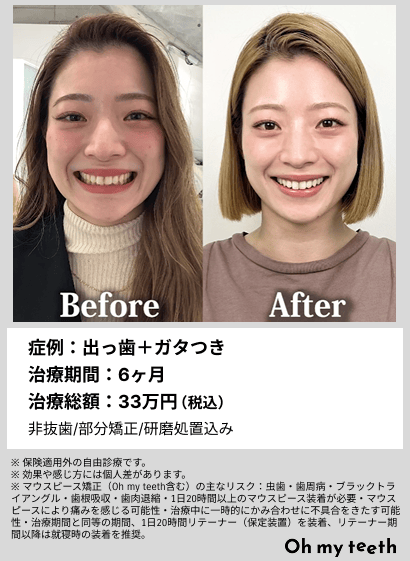 全顔BA・出っ歯＋ガタつき