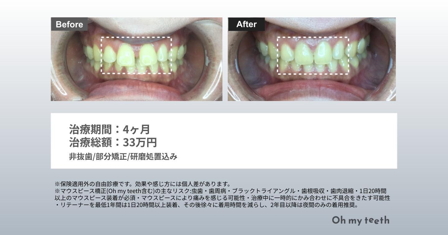 マウスピース矯正 Oh my teethのすきっ歯(空隙歯列)の症例(部分矯正・非抜歯矯正)