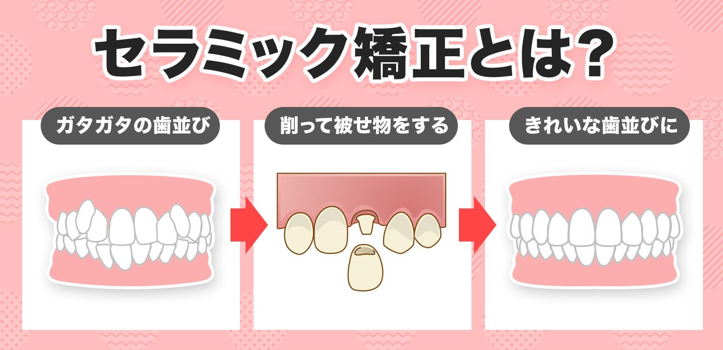 芸能人に人気の「セラミック治療」とは?