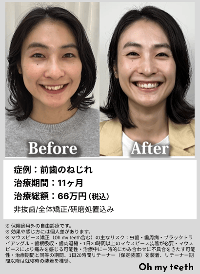全顔BA・前歯のねじれ