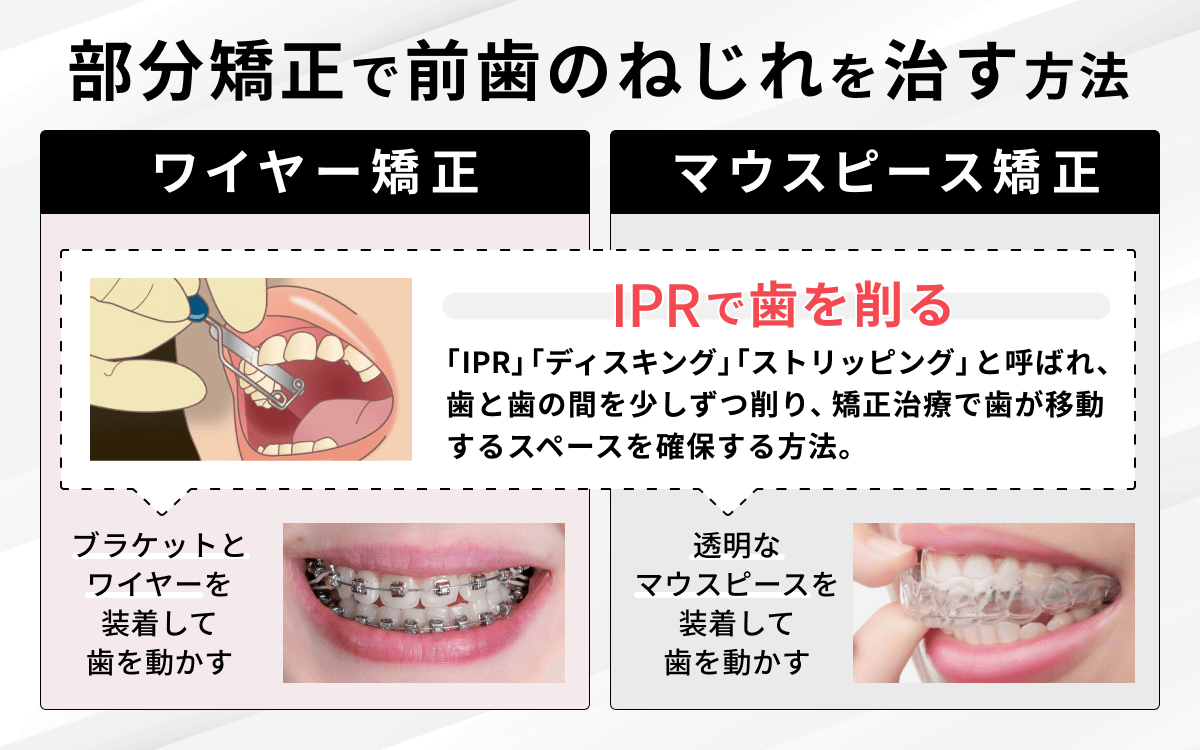 部分矯正で前歯のねじれを治す方法