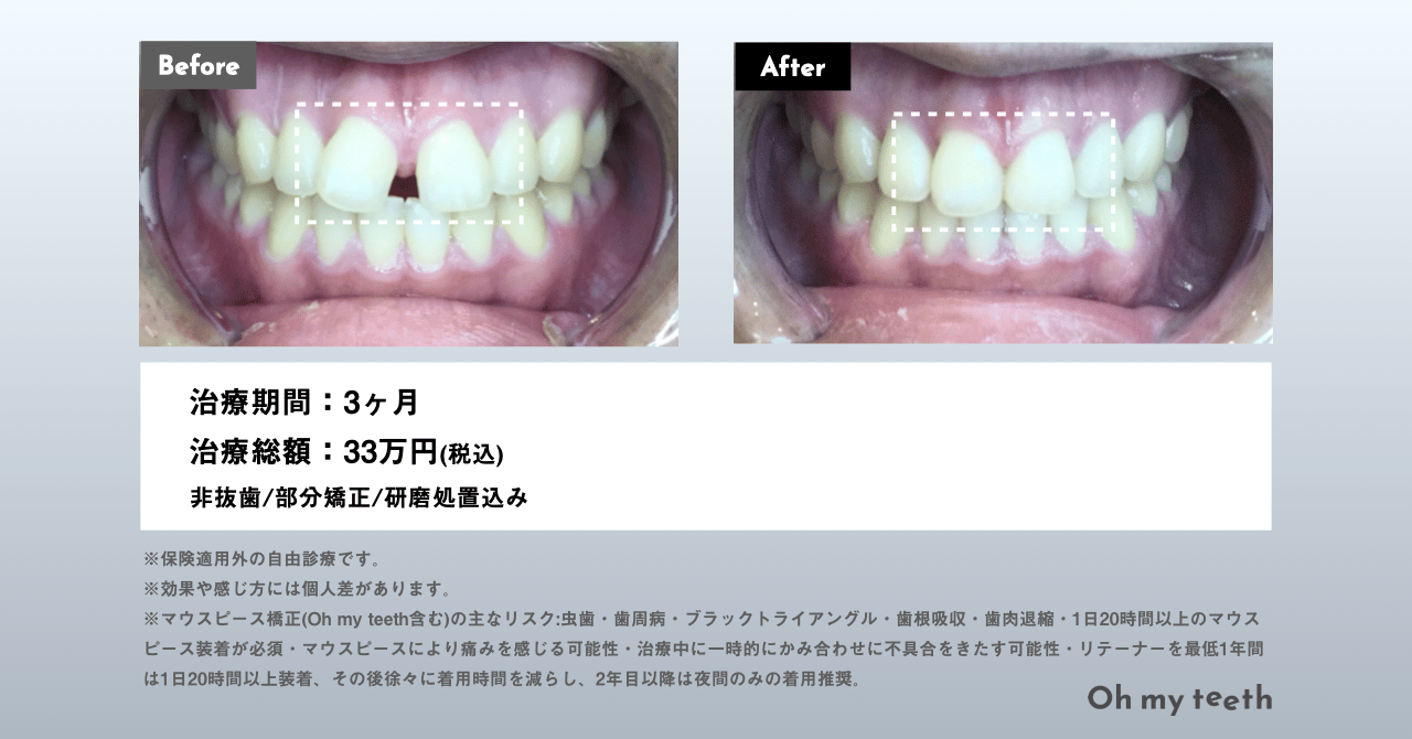 Oh my teethマウスピ�ース矯正の症例画像(すきっ歯)