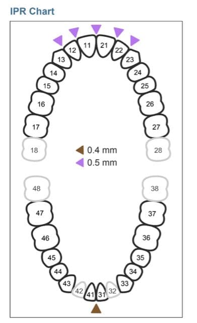 マウスピース矯正 Oh my teethで示される研磨処置の箇所と程度がわかる図
