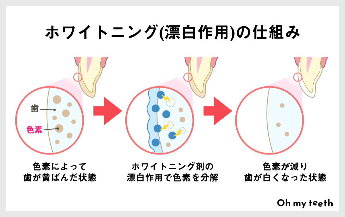 ホワイトニングの仕組みを知って本当に満足できる方法を選ぼう