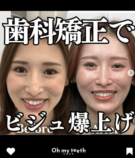 歯科矯正でビジュ爆上げ