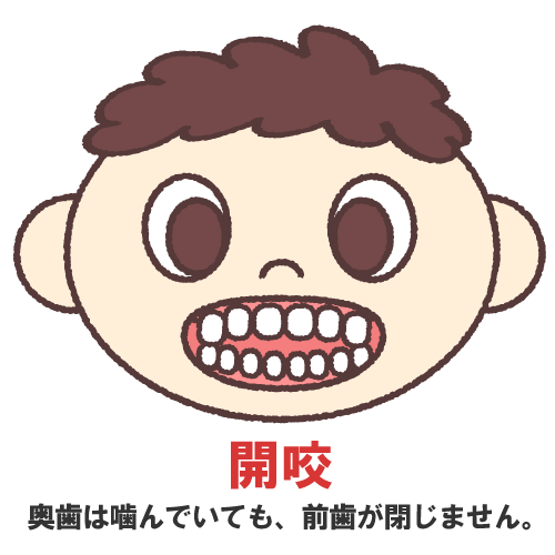 開咬になる原因は?放置してはいけない7つの理由