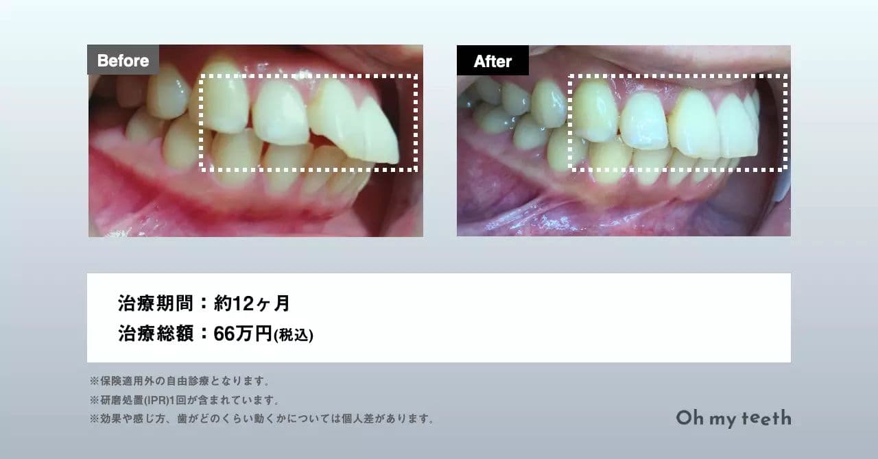 マウスピース矯正 Oh my teethの出っ歯の症例(全体矯正)