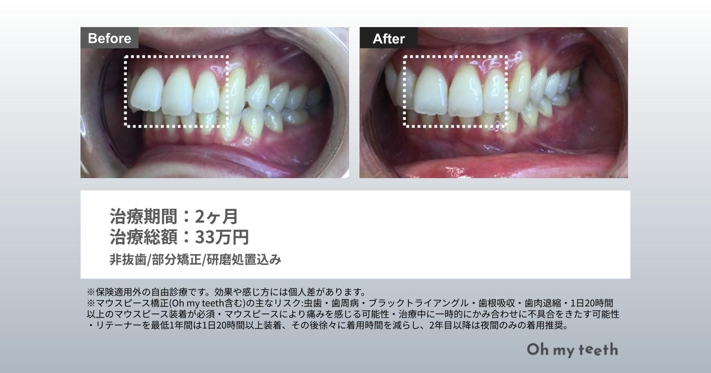 マウスピース矯正 Oh my teethの出っ歯の症例(部分矯正)