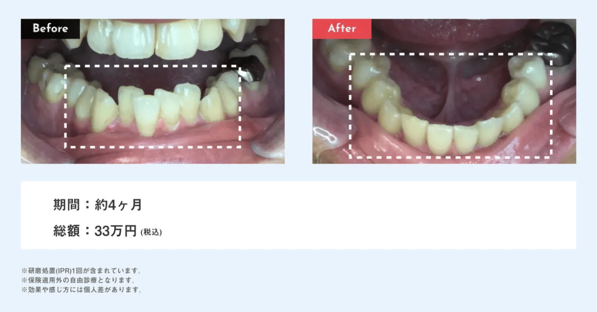 マウスピース矯正 Oh my teethの叢生(ガタガタ)の症例