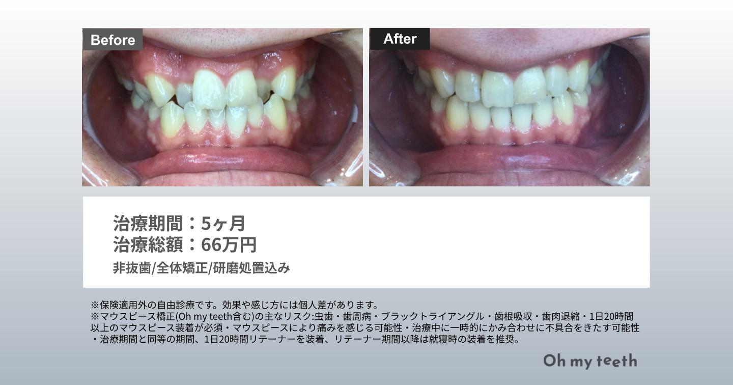 マウスピース矯正 Oh my teethの八重歯の症例(全体矯正)