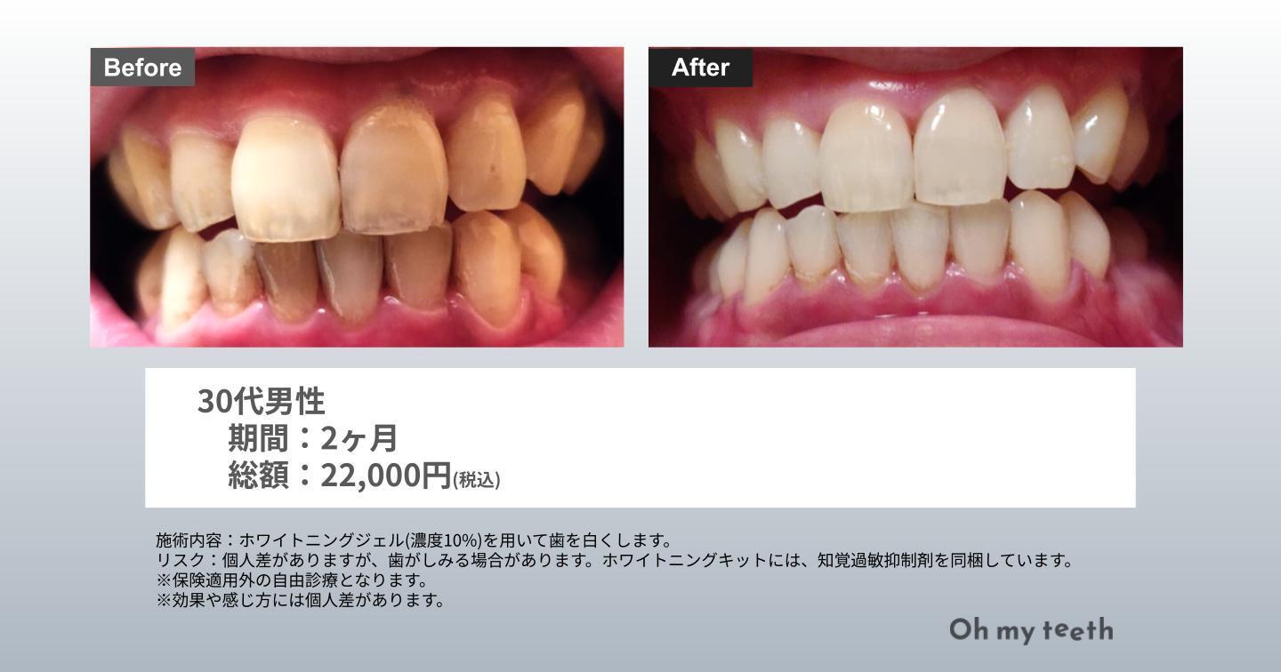 Oh my teeth whitening症例写真