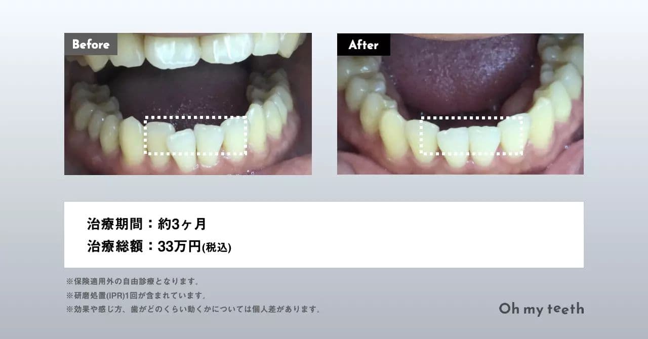 マウスピース矯正 Oh my teethの下の歯のガタガタの症例