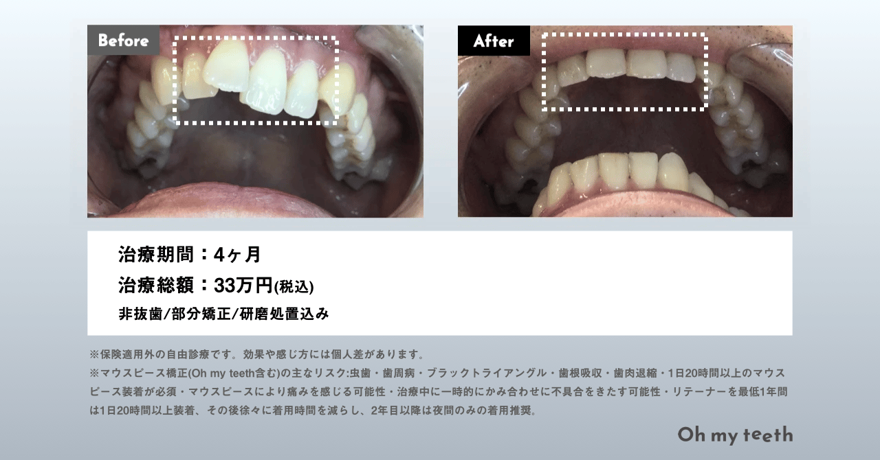 マウスピース矯正Oh my teethの非抜歯矯正(出っ歯)の症例